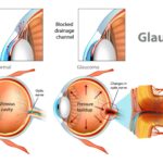 secondary glaucoma