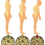 secondary osteoporosis