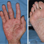 secondary syphilis
