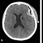seizure occurring during neurosurgery