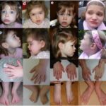 seizures associated with cyclin-dependent kinase-like 5 deficiency disorder