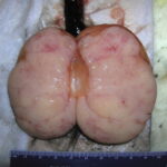 seminoma of testis