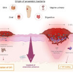 sepsis caused by anaerobic bacteria