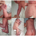 sepsis of newborn