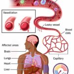 septic shock