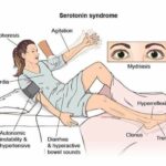 serotonin syndrome