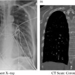 serratia bronchitis