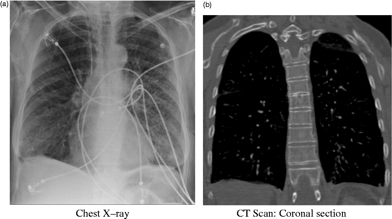 serratia bronchitis