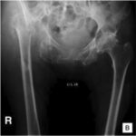 serratia joint infection
