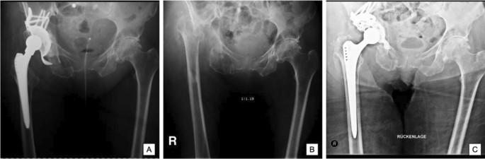serratia joint infection