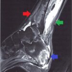 serratia osteomyelitis