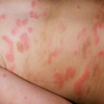 serum sickness