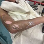severe burns