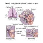 severe chronic obstructive pulmonary disease