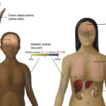 severe malaria
