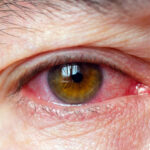 severe ocular inflammation