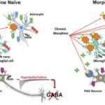 severe pain with opioid tolerance