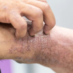 severe pruritus