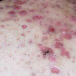 severe recalcitrant nodular acne
