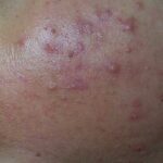 severe recalcitrant nodular rosacea