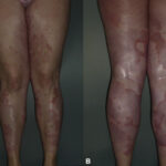 severe recalcitrant psoriasis