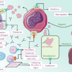 severe thrombocytopenia in refractory chronic immune thrombocytopenia purpura