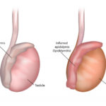 sexually transmitted epididymo-orchitis