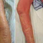 sezary disease
