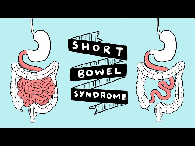 short bowel syndrome