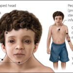 short stature associated with noonan syndrome