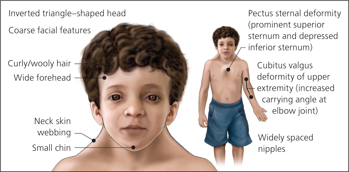 short stature associated with noonan syndrome