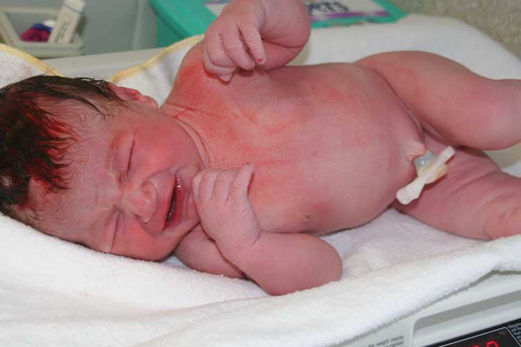 short stature in child born small for gestational age