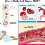 sickle cell disease