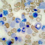 sideroblastic anemia