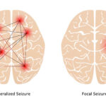 simple-partial epilepsy
