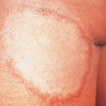 single lesion paucibacillary leprosy