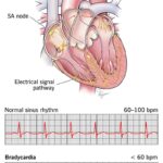 sinus bradycardia