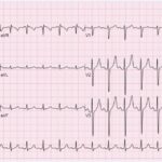 sinus tachycardia