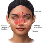 sinusitis