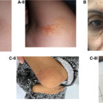 sitosterolemia