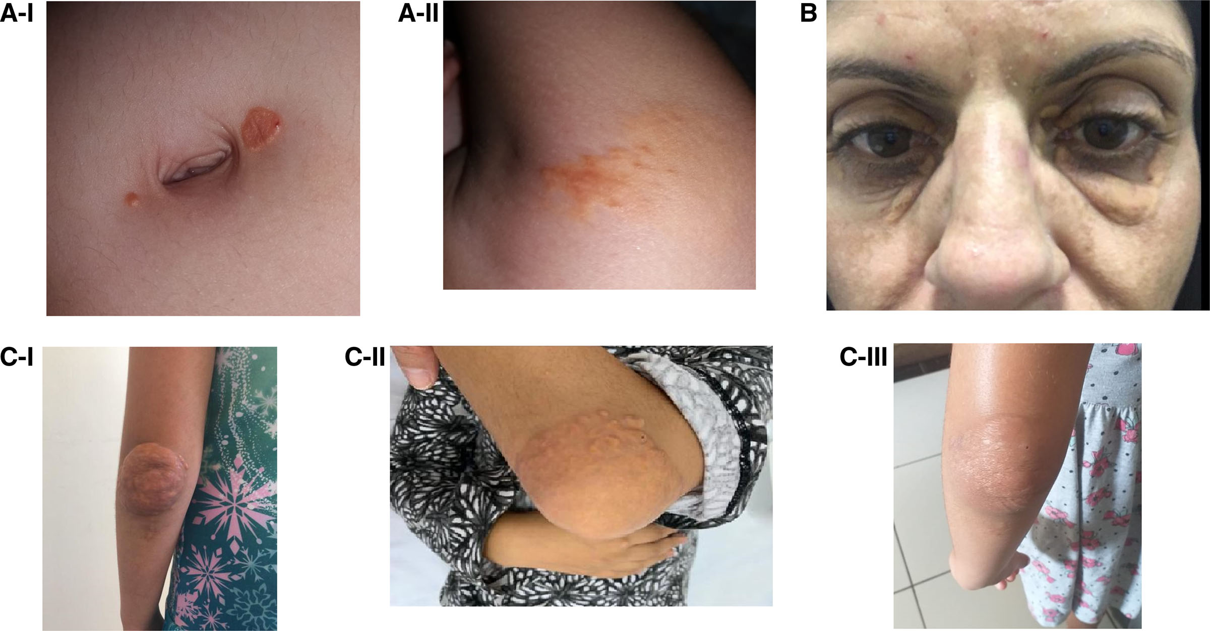 sitosterolemia