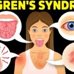 sjogren's syndrome