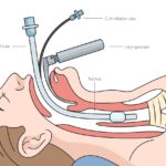 skeletal muscle relaxation for endotracheal intubation