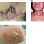 skin and skin structure acinetobacter infection