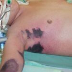 skin and skin structure anaerobic infection