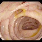 skin and skin structure bacteroides fragilis infection
