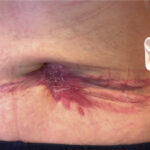 skin and skin structure e. coli infection