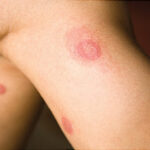 skin and skin structure enterobacter infection