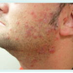 skin and skin structure enterococcus infection