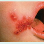 skin and skin structure infection